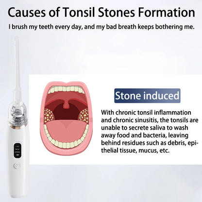 Electric Tonsil Stone Remover – Vacuum & Irrigation Kit