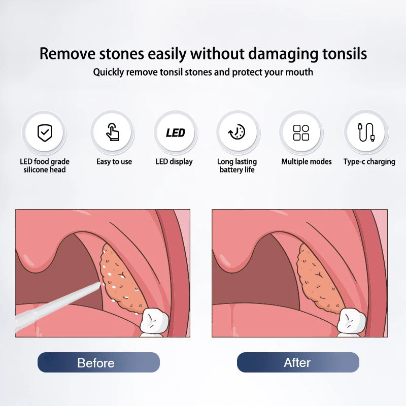 Electric Tonsil Stone Remover – Vacuum & Irrigation Kit
