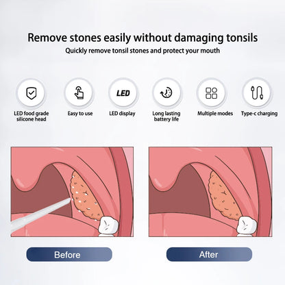 Electric Tonsil Stone Remover – Vacuum & Irrigation Kit